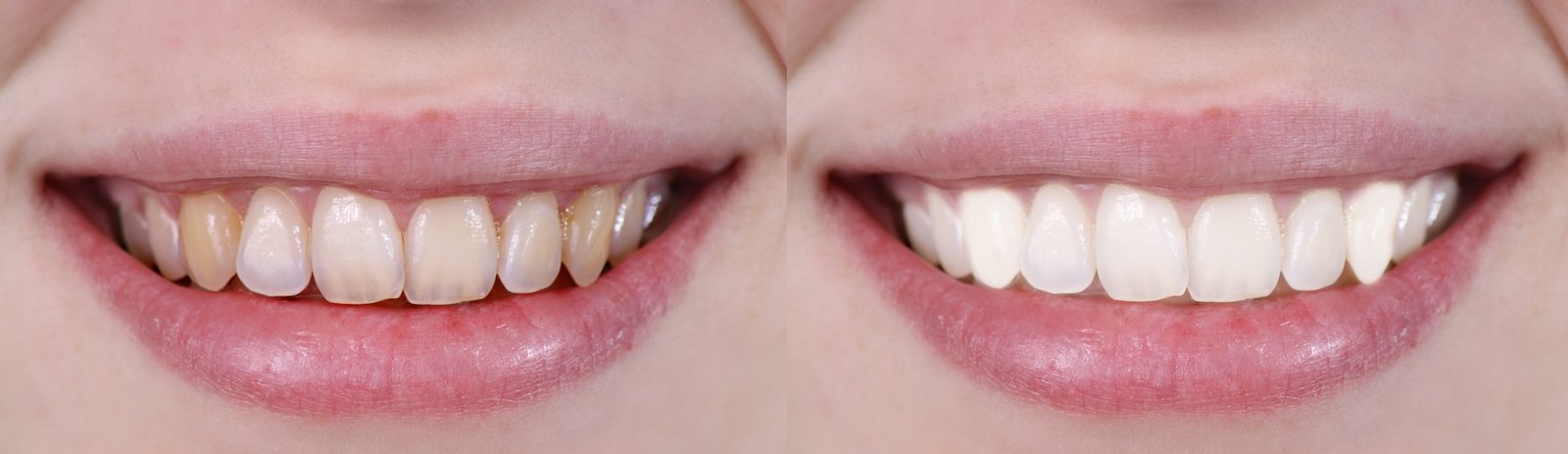 Dantų balinimas prieš ir po