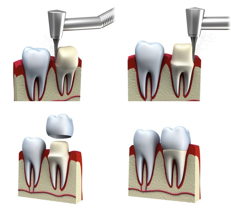 Dantų protezavimas vilnius