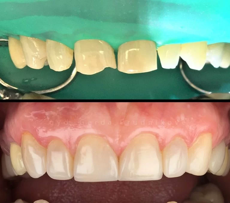 Estetinsi dantų plombavimas