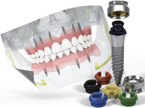 Straumant implantai, Dantų implantacija