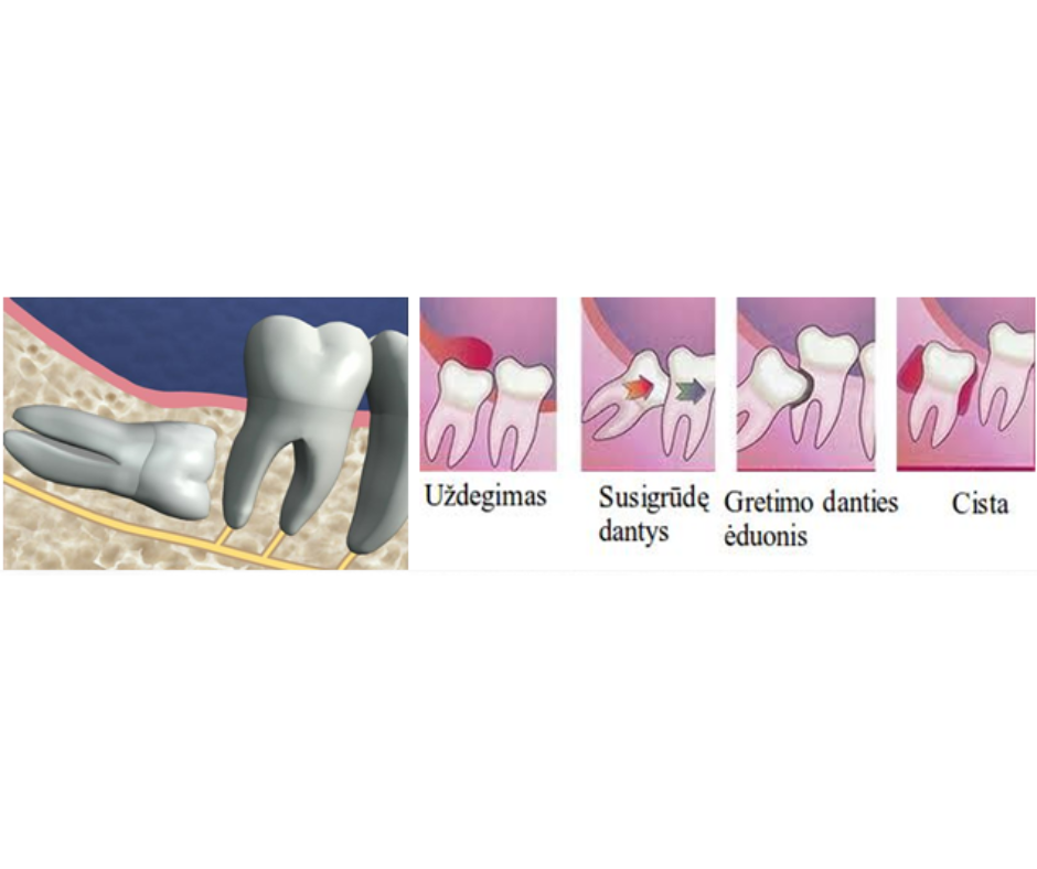 Įprastas protinio danties rovimas