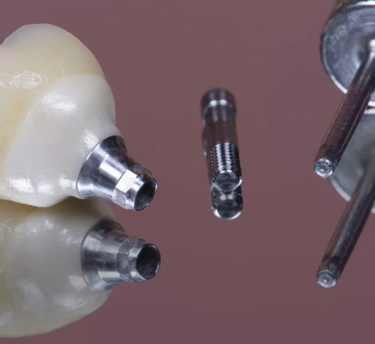 dantų Protezavimas ant implantų