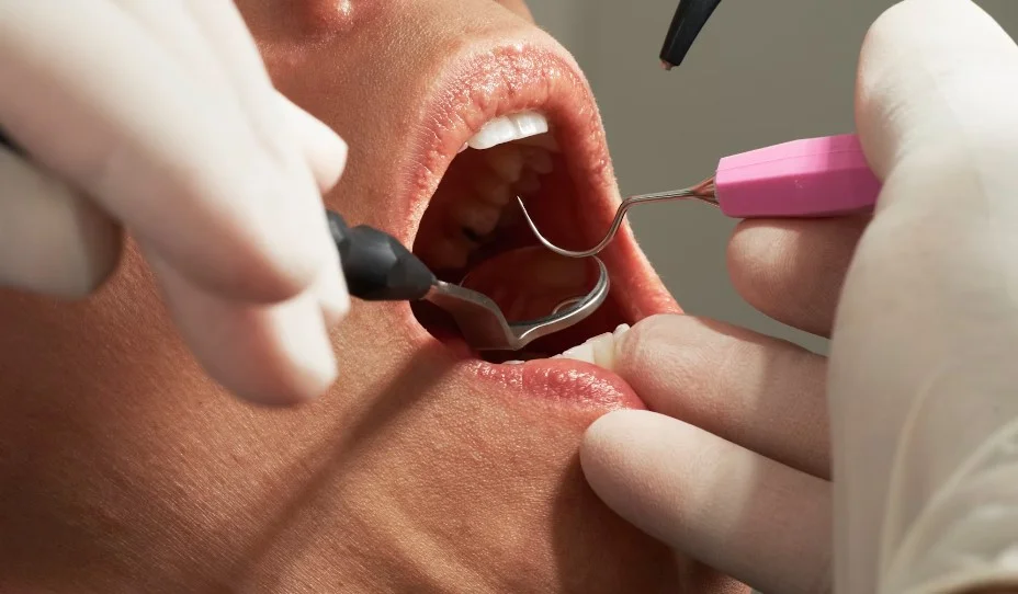 Dantu kanalu gydymas vilniuje