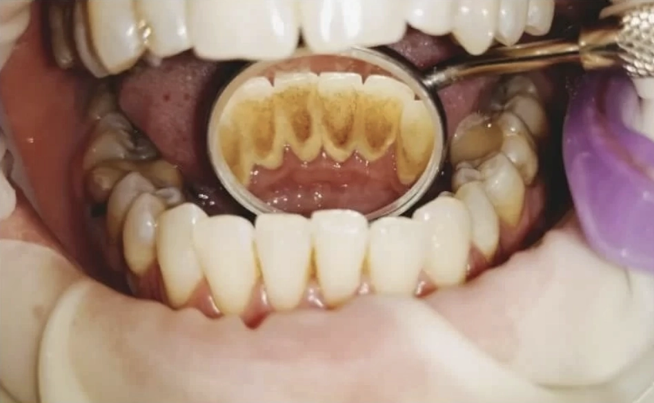 Dantų higiena Pries procedūros Dantų higiena Pries procedūra