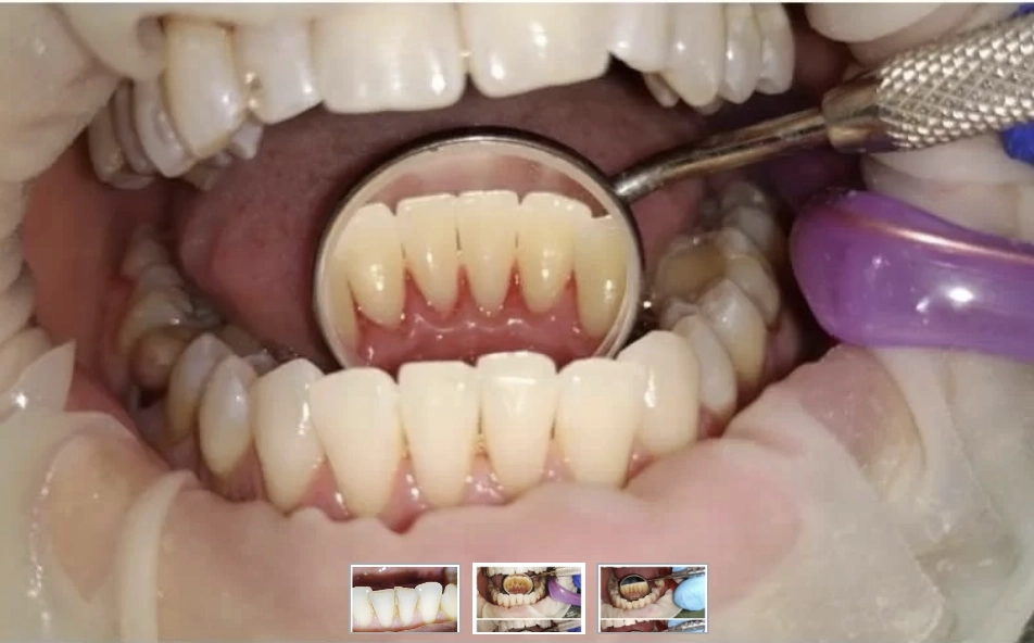 Dantų higiena po procedūros